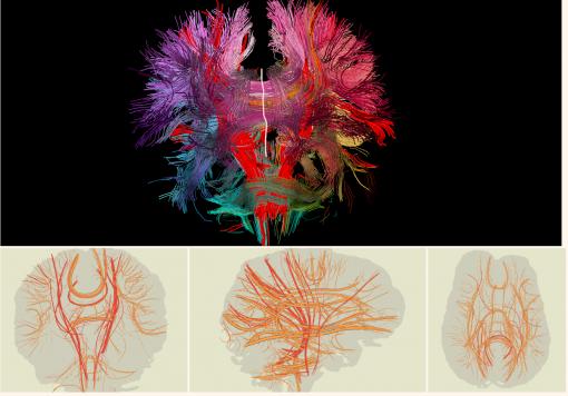 Two-dimensional brain - Researchers at Brown University have created a computer program to advance analysis of the neural connections in the human brain. The program’s special features include a linked view for users to view both the 3-D image (top) and 2-D closeups of the neural bundles.